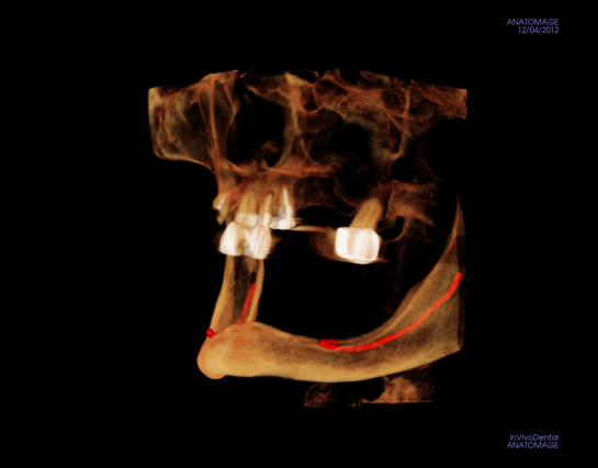 alex-nguyen-dds-deficient-bone-implantview2_3.jpg