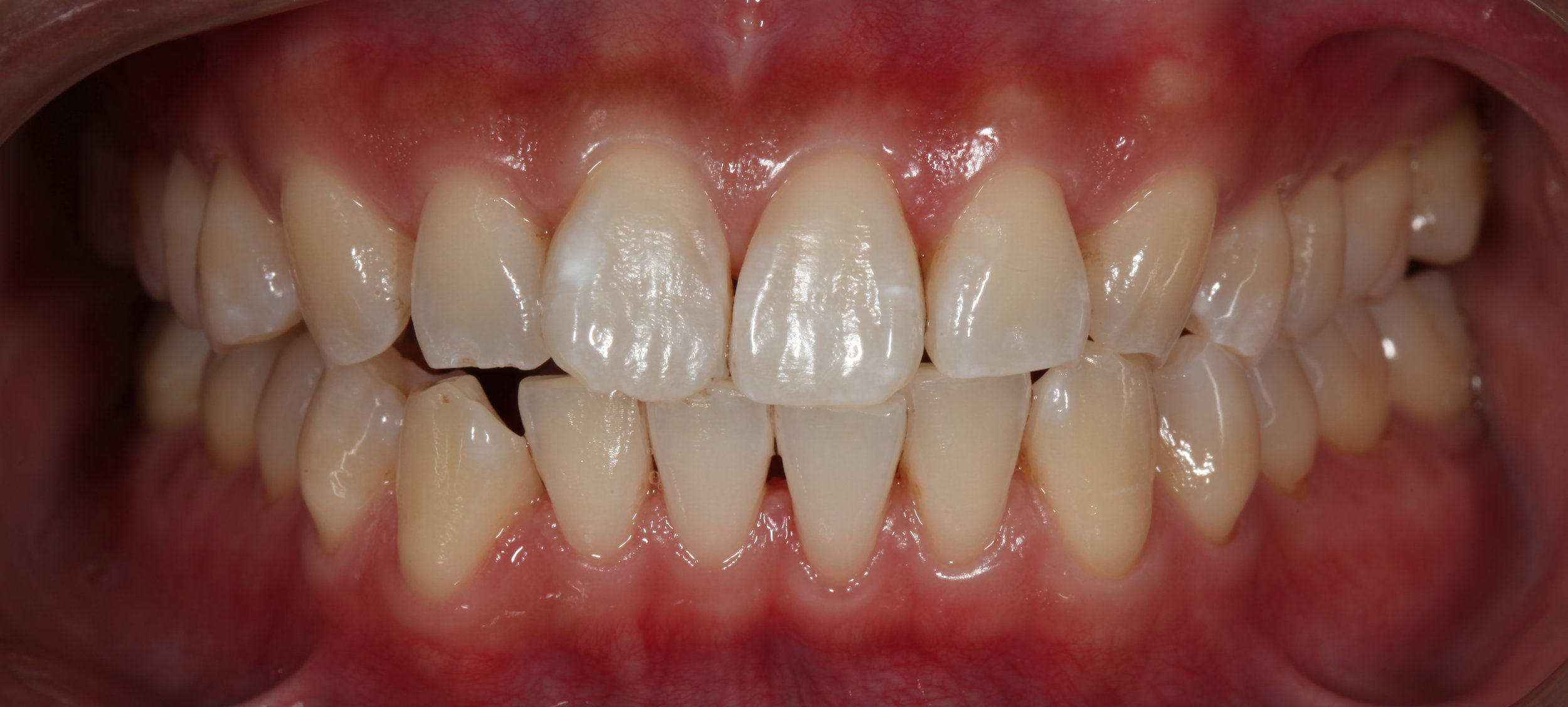 AlexNguyenDDS.Front Teeth1