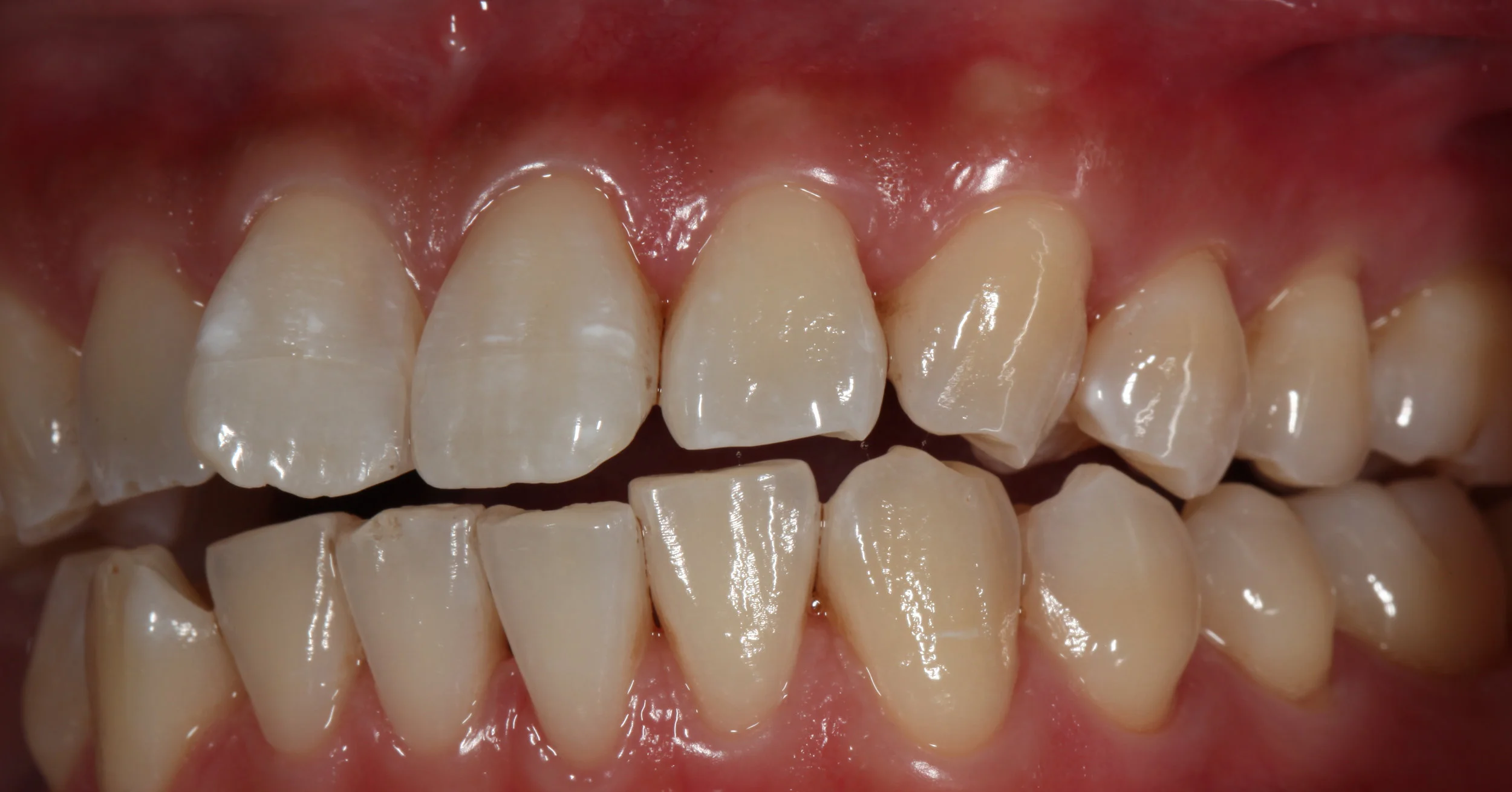 AlexNguyenDDS.FrontTeeth2