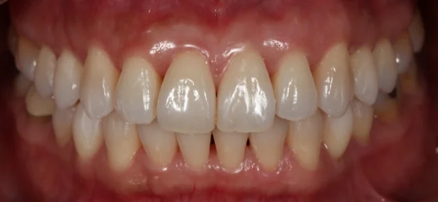 AlexNguyenDDS.AfterInvisalign.jpg