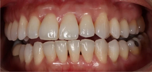 Note only the canines are in contact during grinding movements.