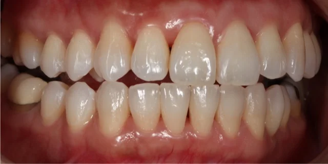 Note only the canines are in contact during grinding movements.