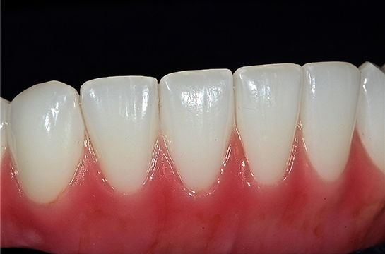 Solid material stained to replicate details found in gum and teeth. In the mouth this prosthesis looks indistinguishable as real teeth or man-made.