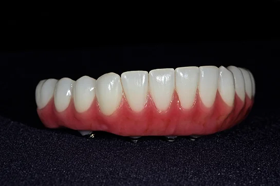This full arch Zirconia bridge is retained by multiple implants in the mouth to help replace missing lower teeth.