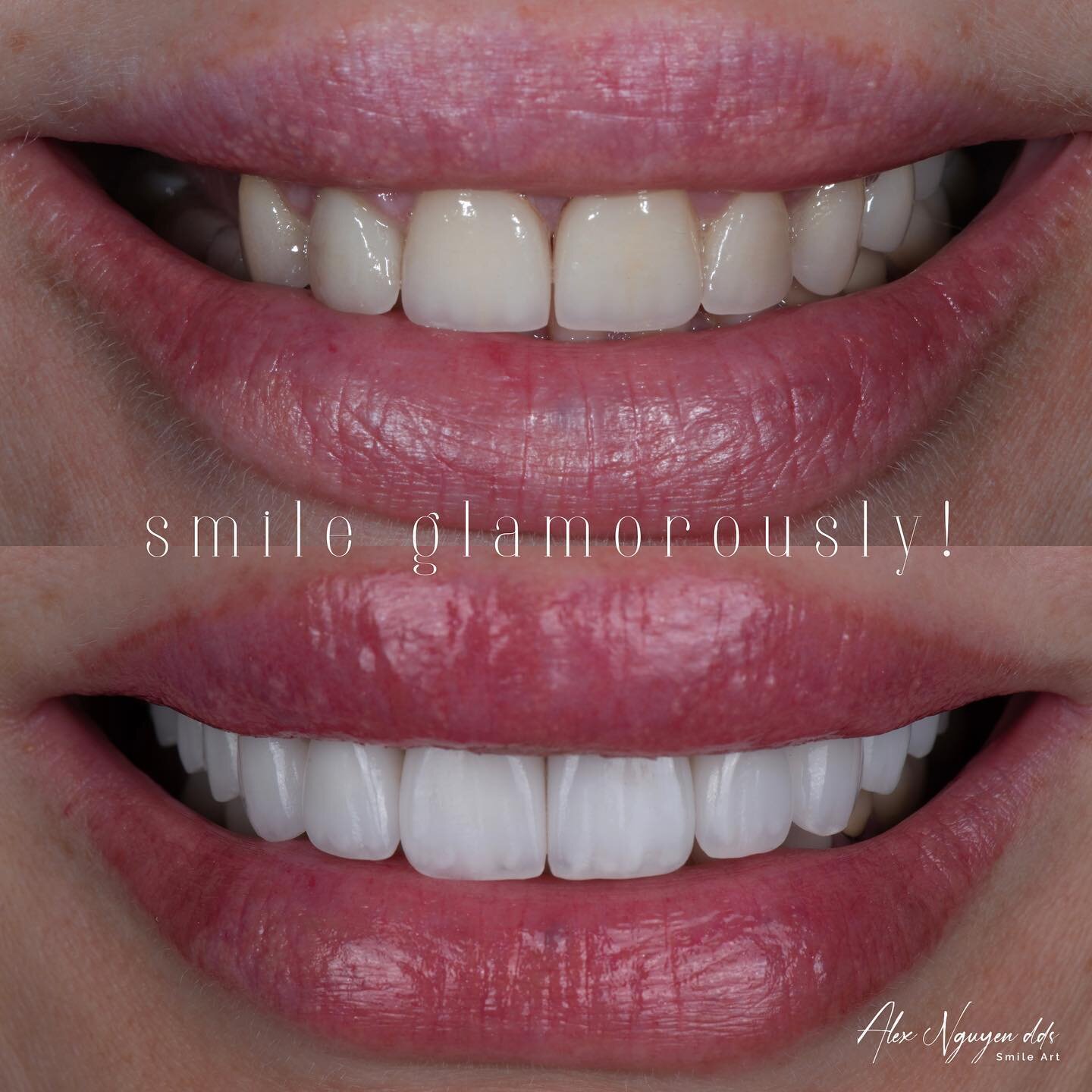 Multiple implants to replace missing teeth; multiple veneers and crowns to brighten up and glamourize this smile.  That was the patient&rsquo;s wish, and she was extremely pleased with the result. 
-
-
-
-
#hollywoodsmile #brightsmile #realisticvenee