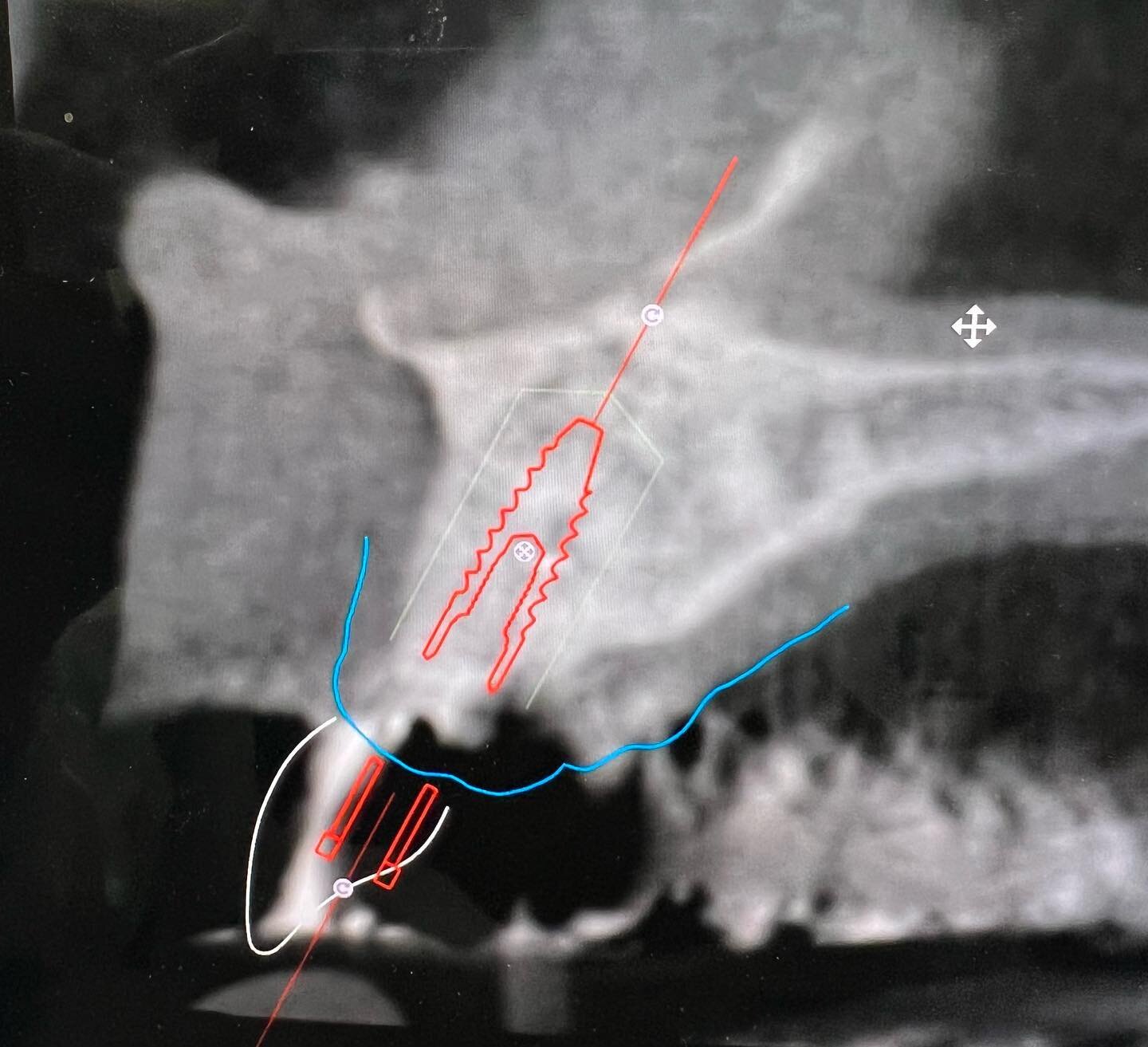 Implant planning is a 3 Dimensional approach.  By combining 3D cone beam scans with today&rsquo;s advanced digital software,  we can precisely plan and preselect the implant size before the surgery.
In this particular case, because of the location of