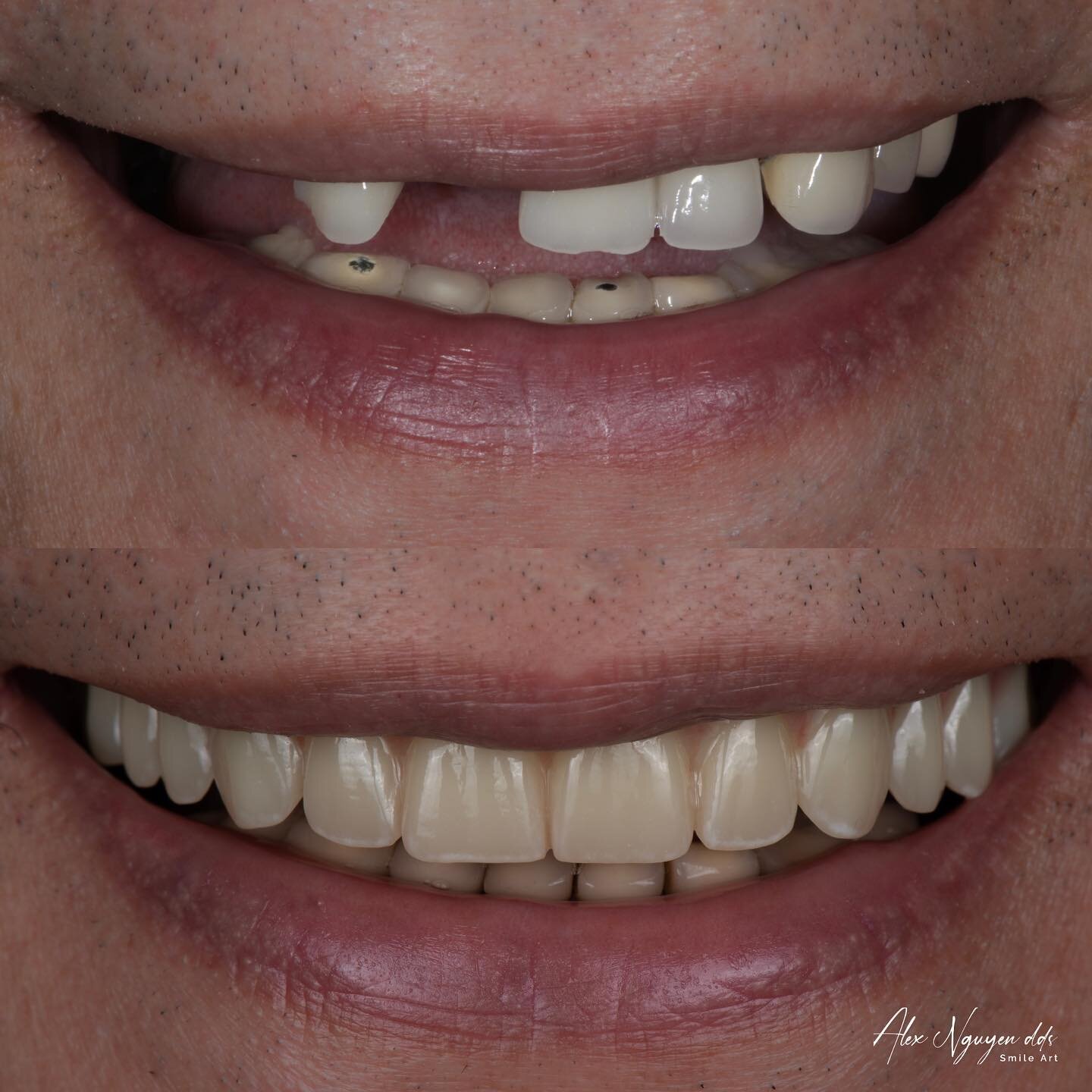 My patient had root canals and crowns done on every single tooth.  The crowns were extremely bright and unnatural.  Over the years his teeth started to break down one by one.

Using 5 implants to support a full arch zirconia prosthesis, I was able to