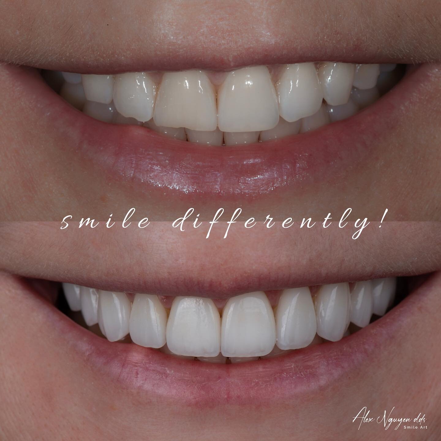 Notice the lip line change after the smile has been enhanced.  When the patient is no longer conscious of chipped and uneven smile line, the lips move naturally to display a wider and more dynamic smile.
-
-
-
-
#smiledesign #porcelainveneers #beauti