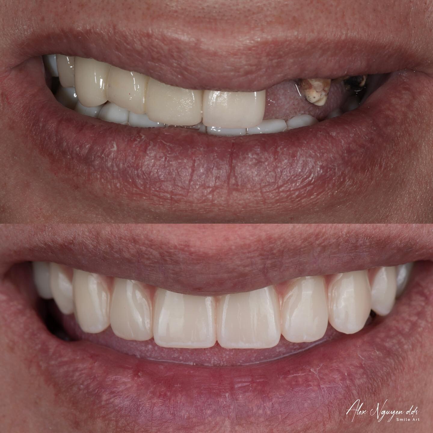 My patient said &ldquo;No!&rdquo; To denture and chose fixed implant retained zirconia prosthesis.
When planned and executed meticulously the result is a stunning realistic smile that also allows the patient the ability to chew efficiently.
Are you s