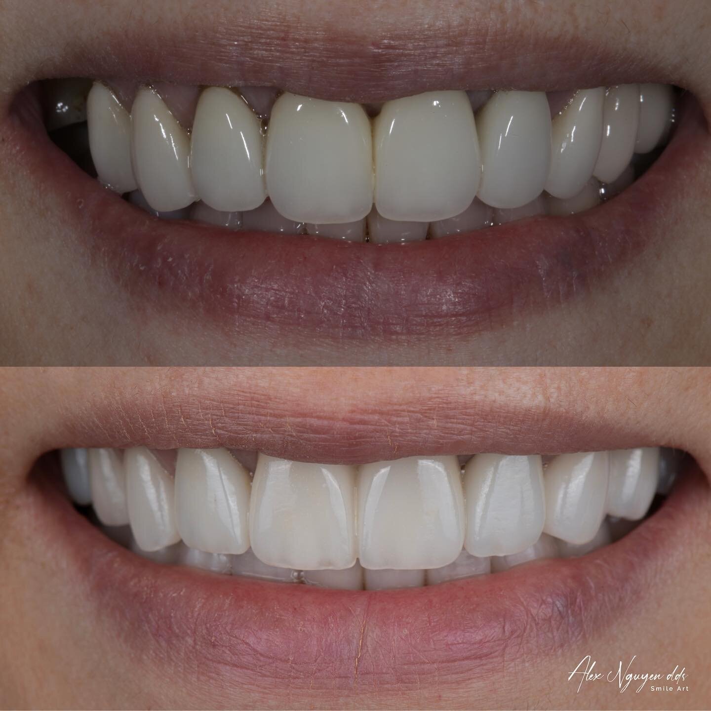 Refresh.  Rejuvenate.  Rejoice. 

A full mouth reconstruction case we just finished.  My patient needed her open bite corrected so that she can chew efficiently.  The result of &ldquo;form follows function&rdquo; is a beautiful smile she will cherish