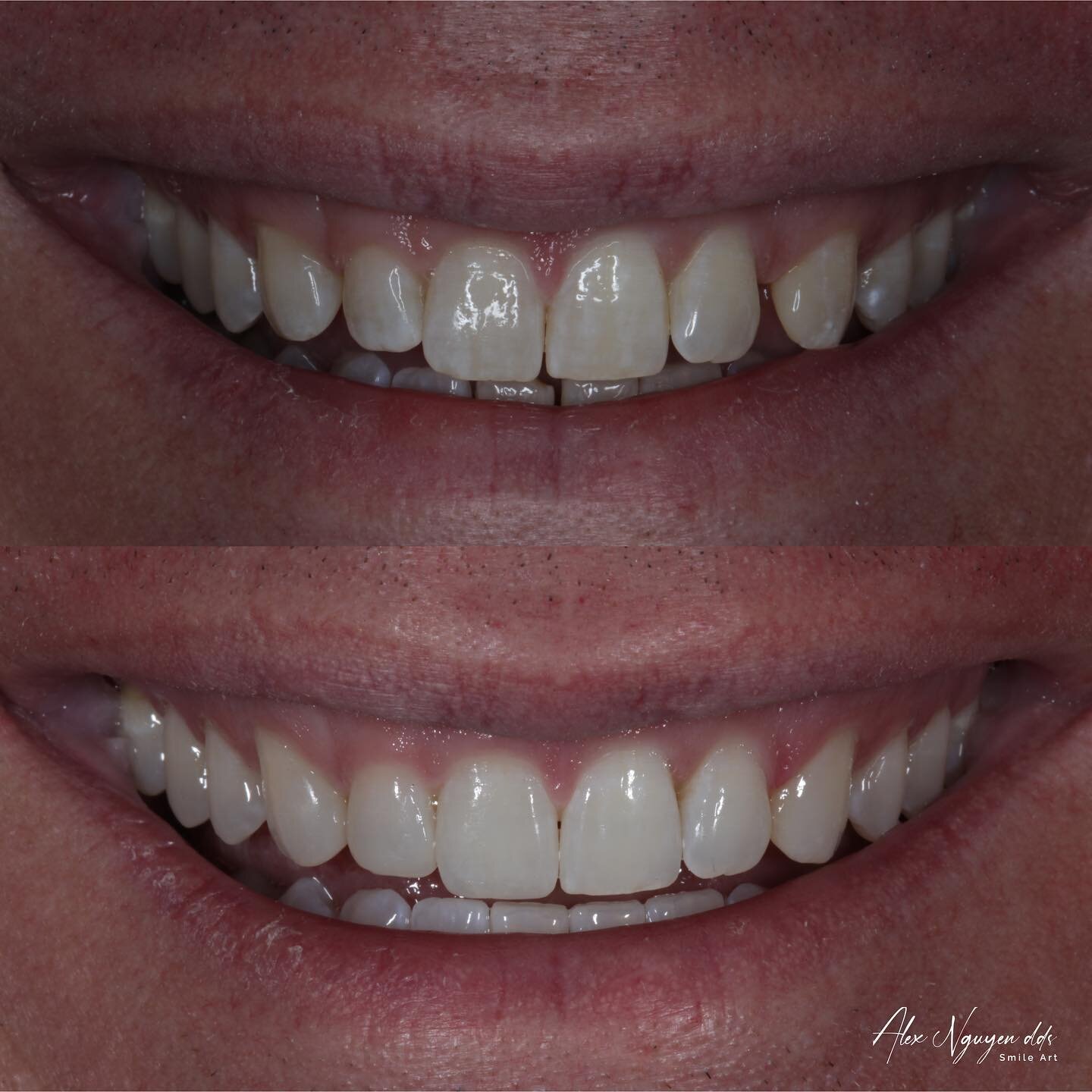 What to do with an uneven smile with gaps?
This patient spent 7 months in Invisalign treatment.  Then he bleached his teeth for a brighter shade.
Finally we did some conservative bondings at select locations to complete the new smile. 
-
-
-
-
#invis
