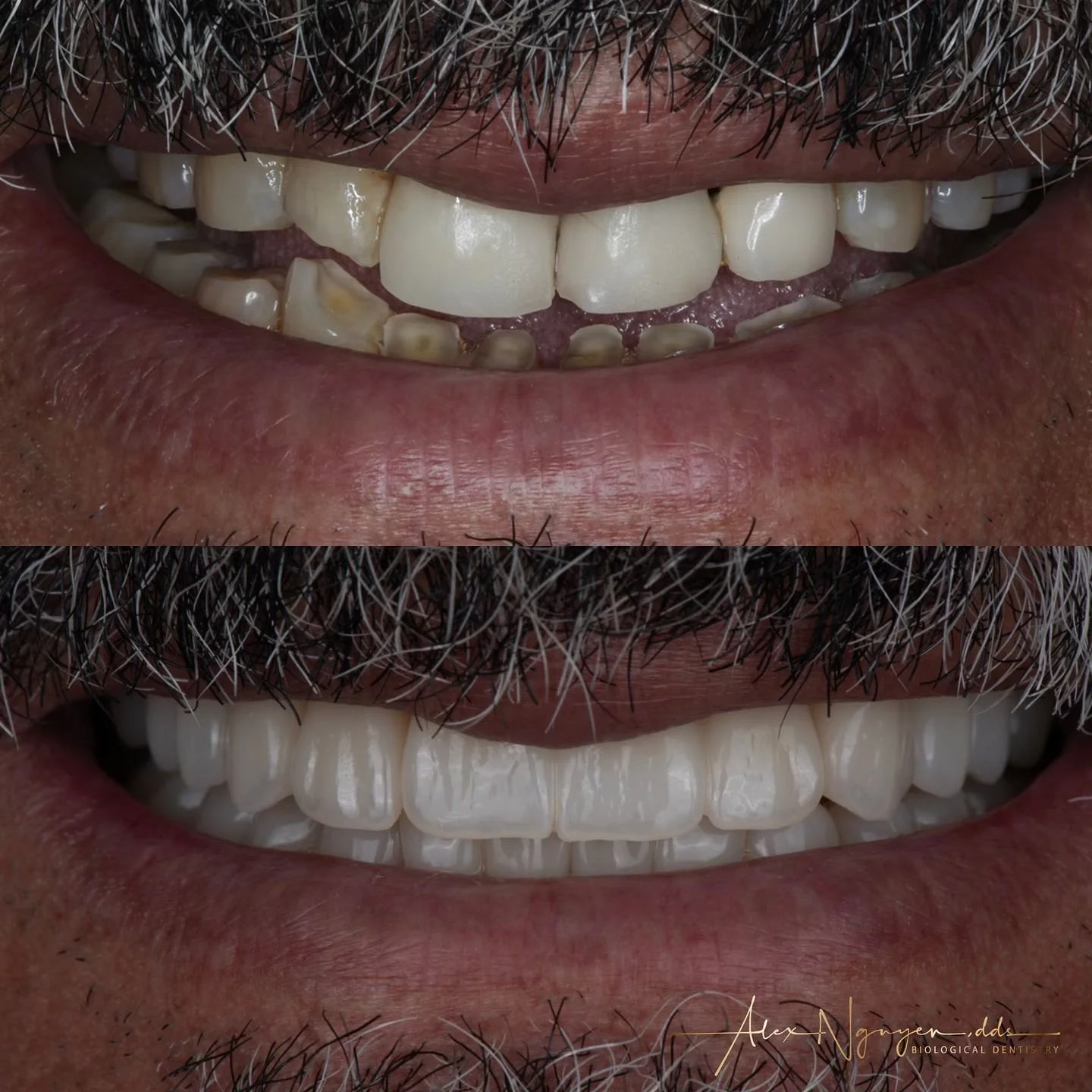 My patient needed a full mouth reconstruction to restore a bite that wore down his teeth severely. By applying the principle of Gneuromuscular Dentistry, Digital Dentistry, Modern Dental Materials, and Artistic Concepts I was able to restore this wor