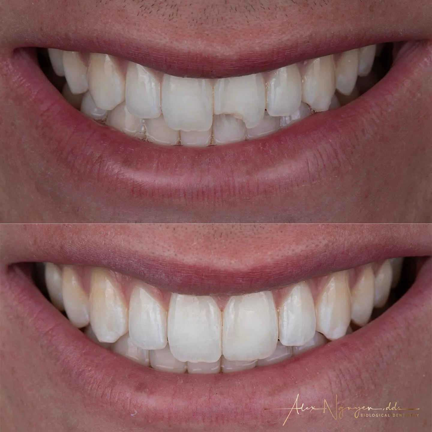 Summer fun had the best of my patient&rsquo;s front tooth, so we did an emergency bonding appointment to get him going again.
Sometime this is all the patient needs, but if the resin starts to break down we have other solutions.
-
-
-
-
#smile #fract