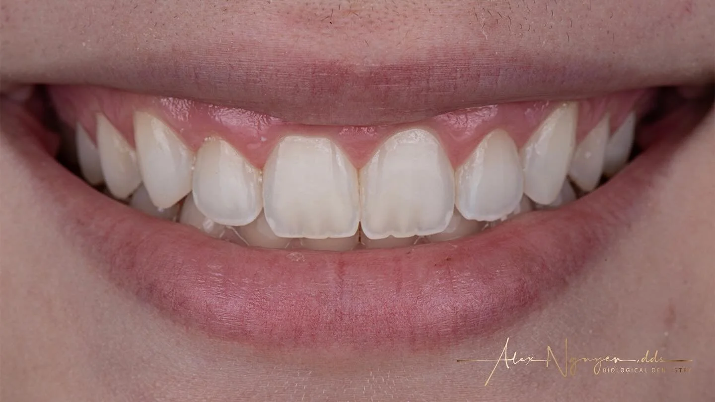 Can you tell what we did in this smile?  We simply softened the look of the canines with some conservative resin bondings.
Swipe left ⬅️ to see the &ldquo;before&rdquo; image.
- 
-
-
-
#resinbonding #postorthodontictreatment #alexnguyendds #biologica