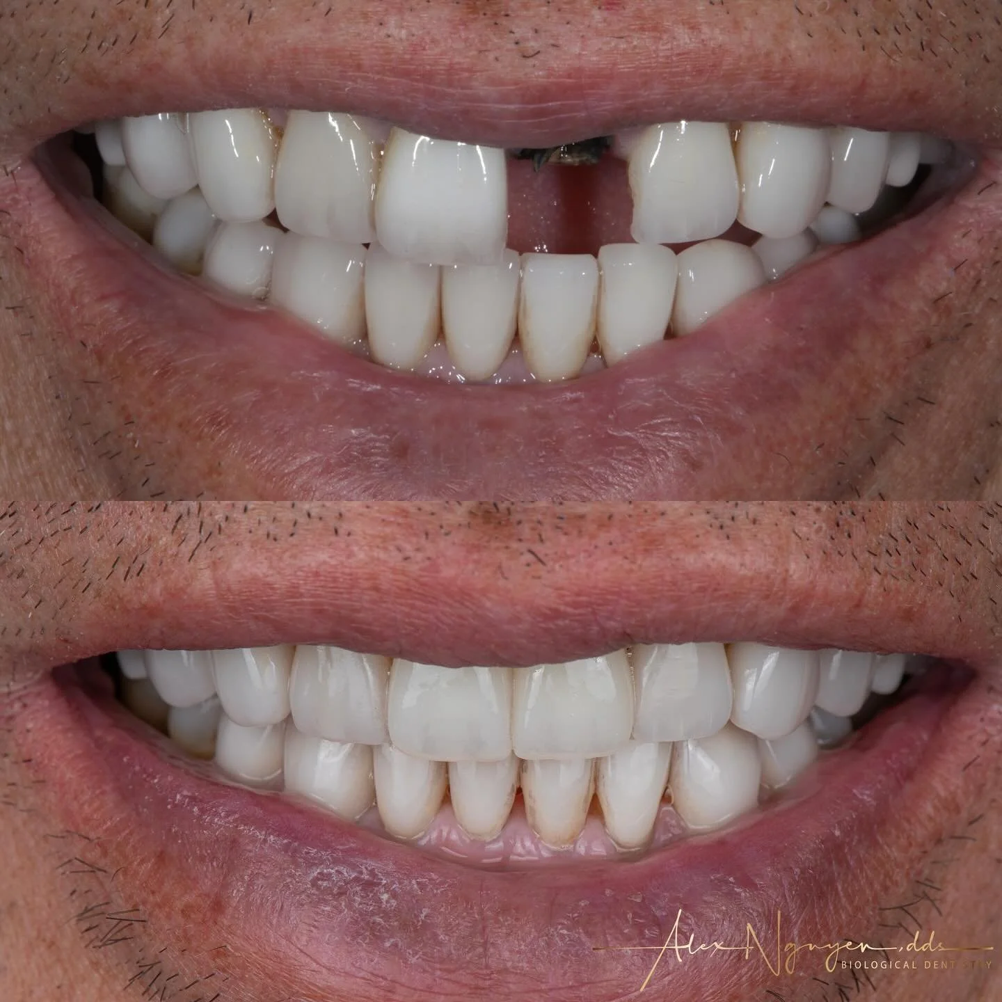 Replacing failed root canal treated teeth with zirconia implants and zirconia crowns.

Root canal treated teeth are dead roots.  Basically they are dead body parts that will eventually break down.  In this case my patient has sustained the two front 