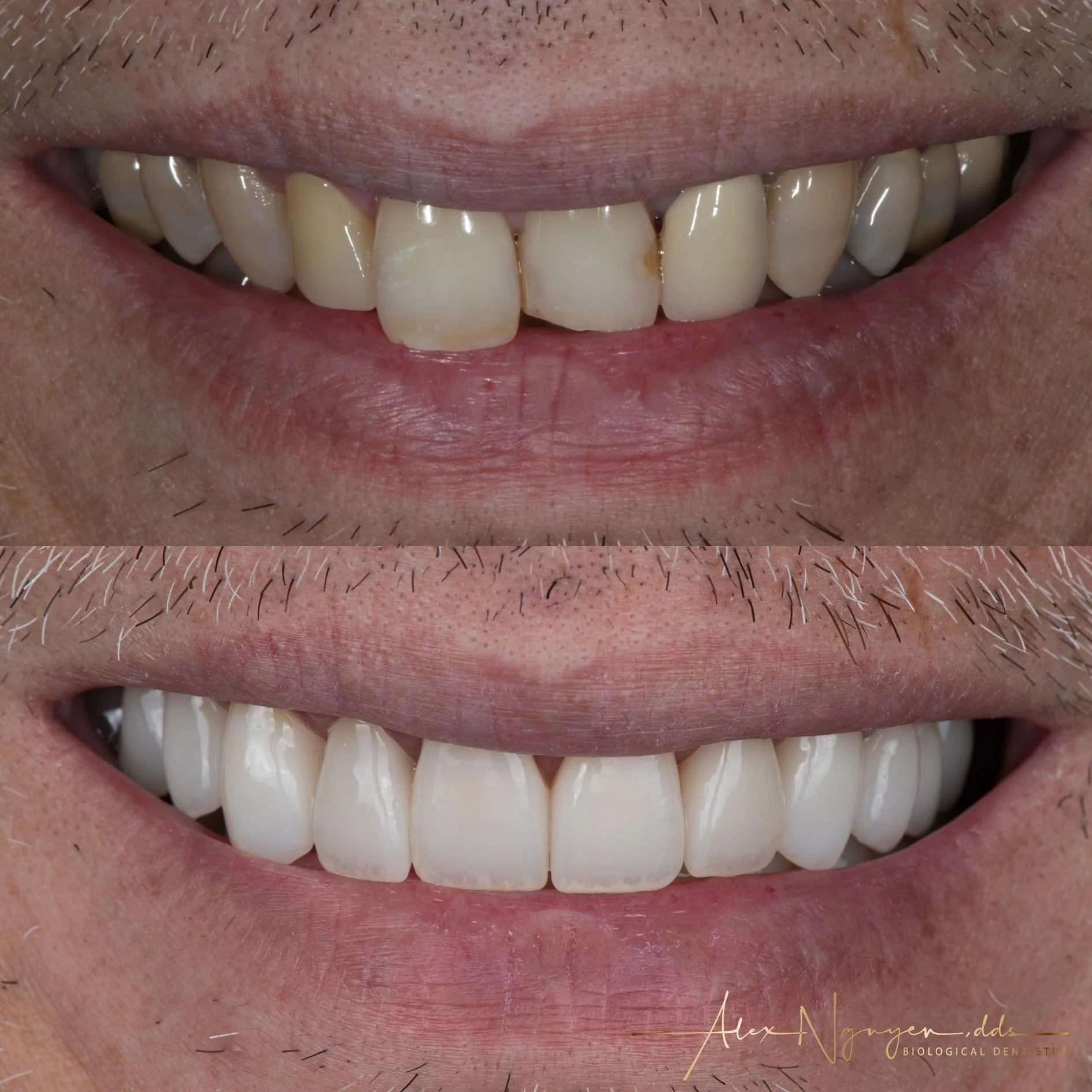 Roughing it with a full mouth restoration.

My patient said if he knew I was taking pictures he would have shaved.  I told him I was only interested in the teeth 😁.
All joking aside, this was a fun case and as with every smile there is always a stor