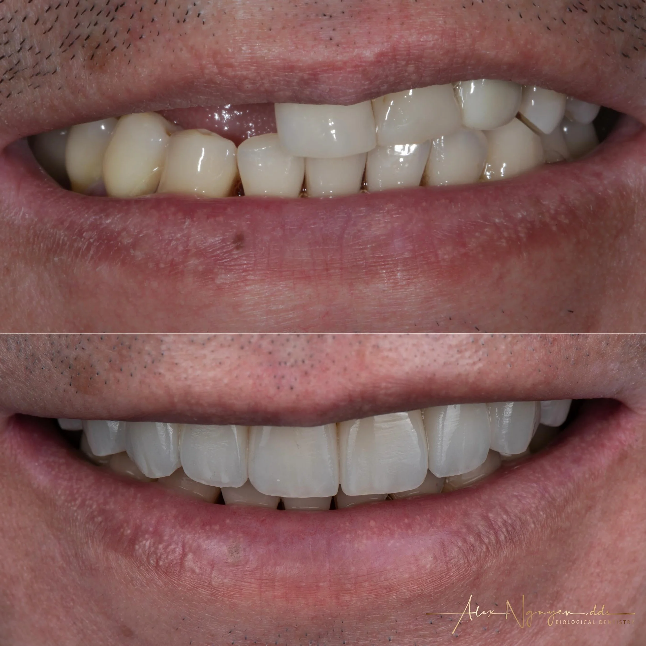 Spring forward with a new smile.  Another case of complex multiple implants, crowns, and veneers.
-
-
-
#smilemore #naturalsmile #nochicletteeth #smilemakeover #dentist #bayareadentist #smilelifeistooshort #naturallookingsmilemakeover #alexnguyendds 