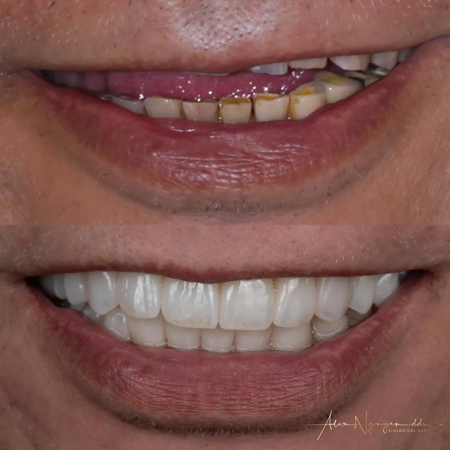 Can you say &ldquo;cheese&rdquo;? This is full mouth reconstruction case.
I rebuilt this patient&rsquo;s collapsed bite due to years of uncontrolled grinding.  He came to me with multiple types of implants and crowns, and over the years he could not 