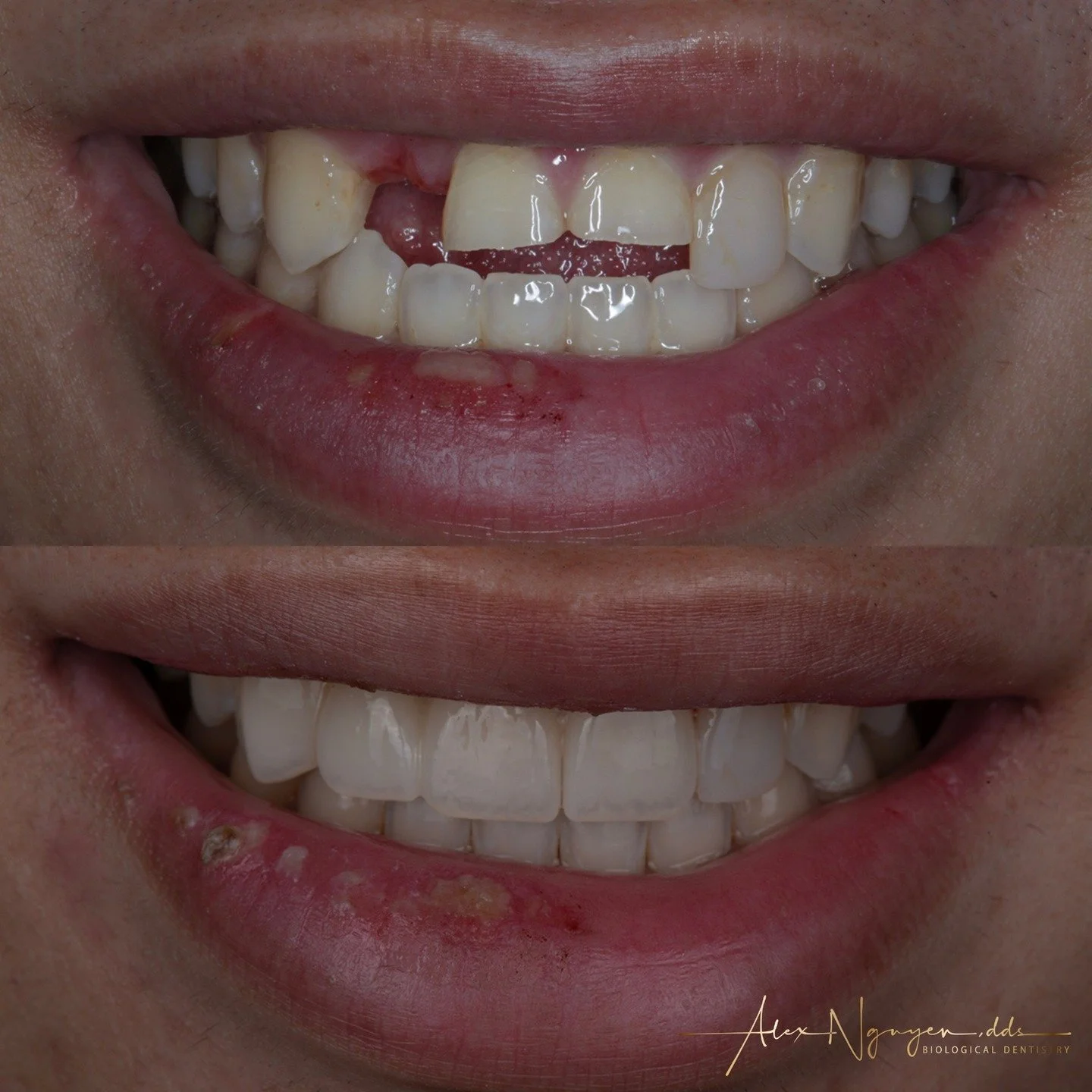 Emergency teeth replacement in less than 24 hours.
My patient played intramural basketball in college...got elbowed in the face, and broke off his front teeth.
We scheduled an emergency treatment to accommodate his busy schedule, and the need to imme