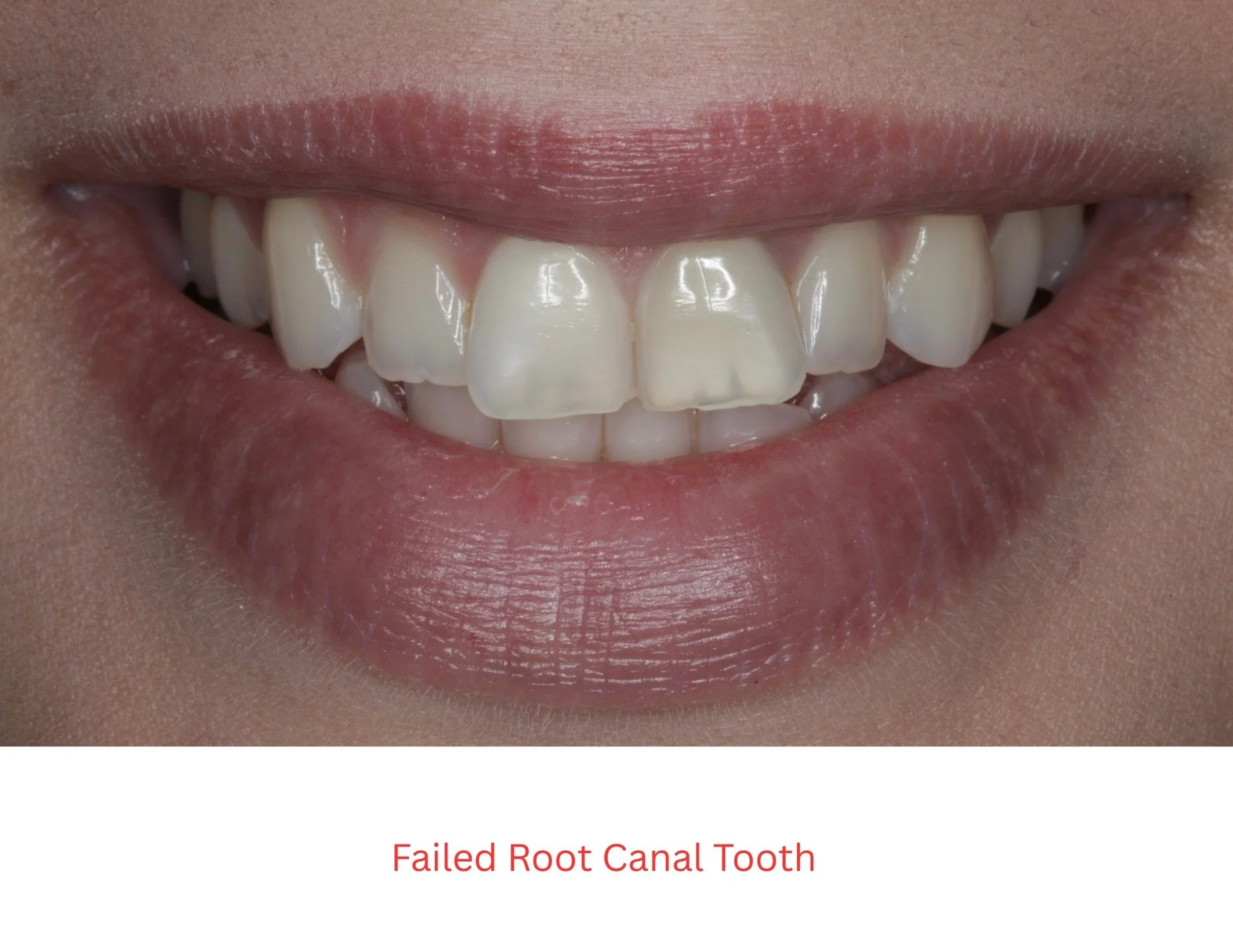 WARNING: GRAPHIC CONTENTS OF SURGICAL TREATMENT!!

Management of a failed root canal tooth from extraction, to bone grafting, to temporization. THIS! Is the magic of Biological Dentistry.

Are you losing a front tooth, and are afraid of the treatment