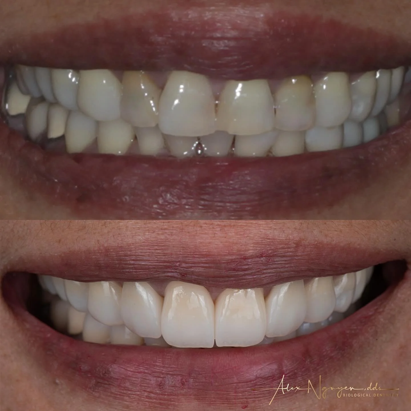 My patient wanted to improve the look of her front teeth in her smile without changing anything else. 
In a case like this the challenge is for the restorations to blend in with the natural dentition in a way that they don&rsquo;t scream out loud &ld