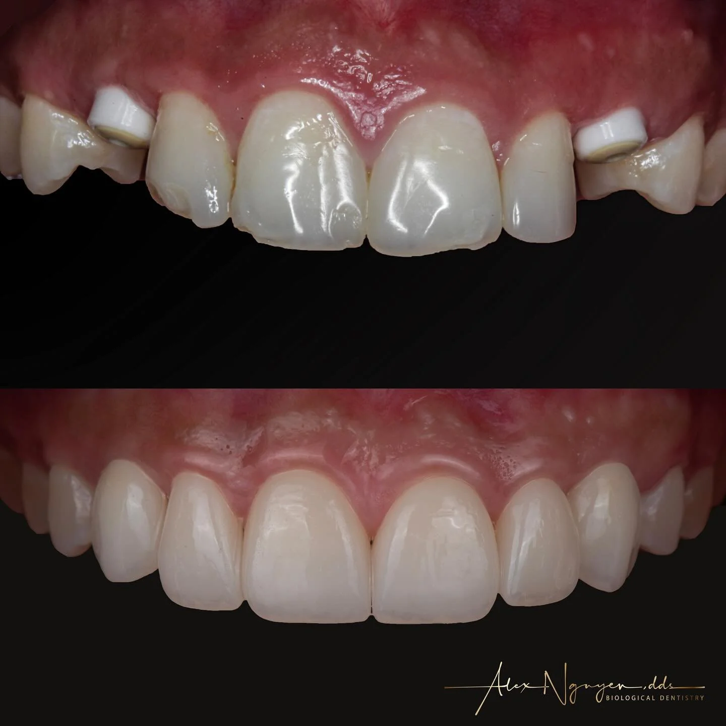 2 zirconia implants and 6 solid zirconia restorations to complete this patient&rsquo;s smile.
Zirconia implants are known to have superior biocompatibility. Solid zirconia restorations when characterized well will look realistic and are also the most