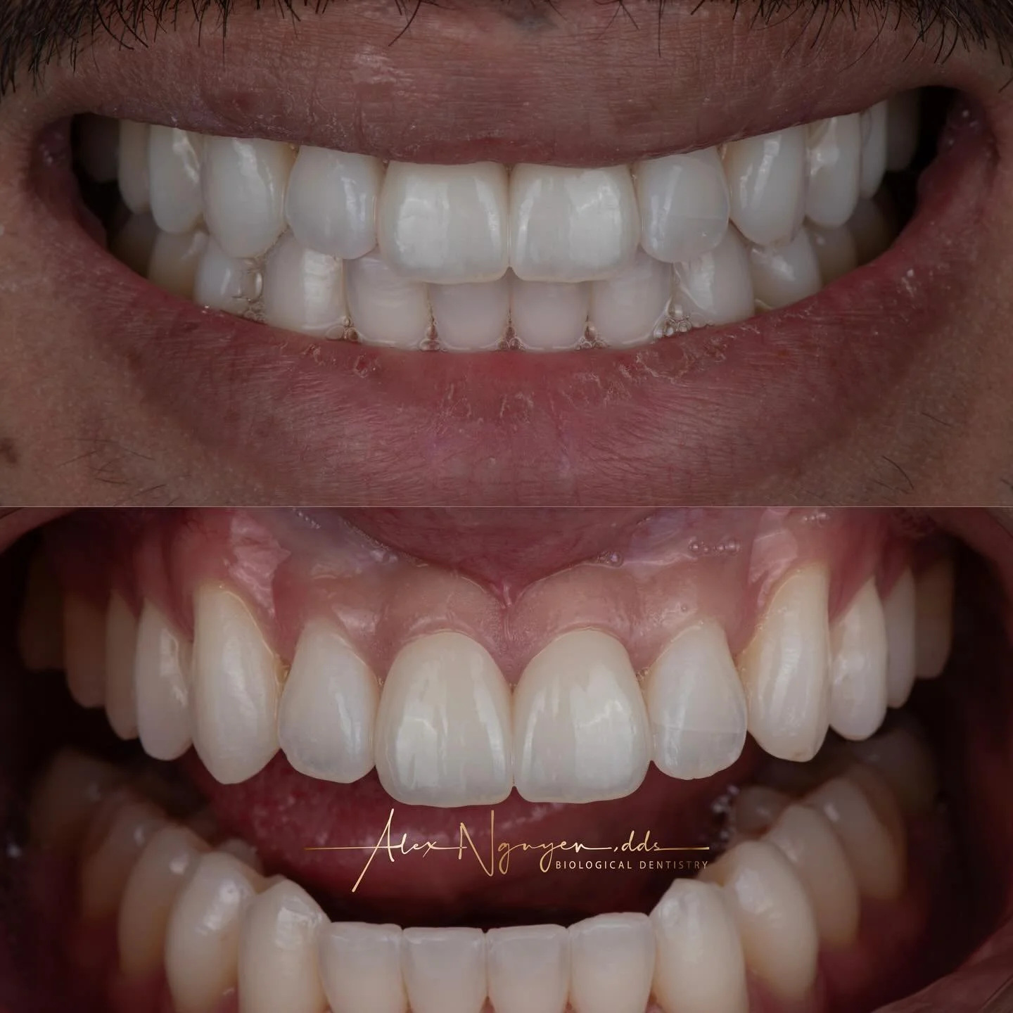 My patient broke his two front teeth, so we prepared two porcelain restorations to replace them.  The photos were taken at the tryin. After final cementation, the underlying tooth colors will blend in with the ceramics to enhance the look of the rest