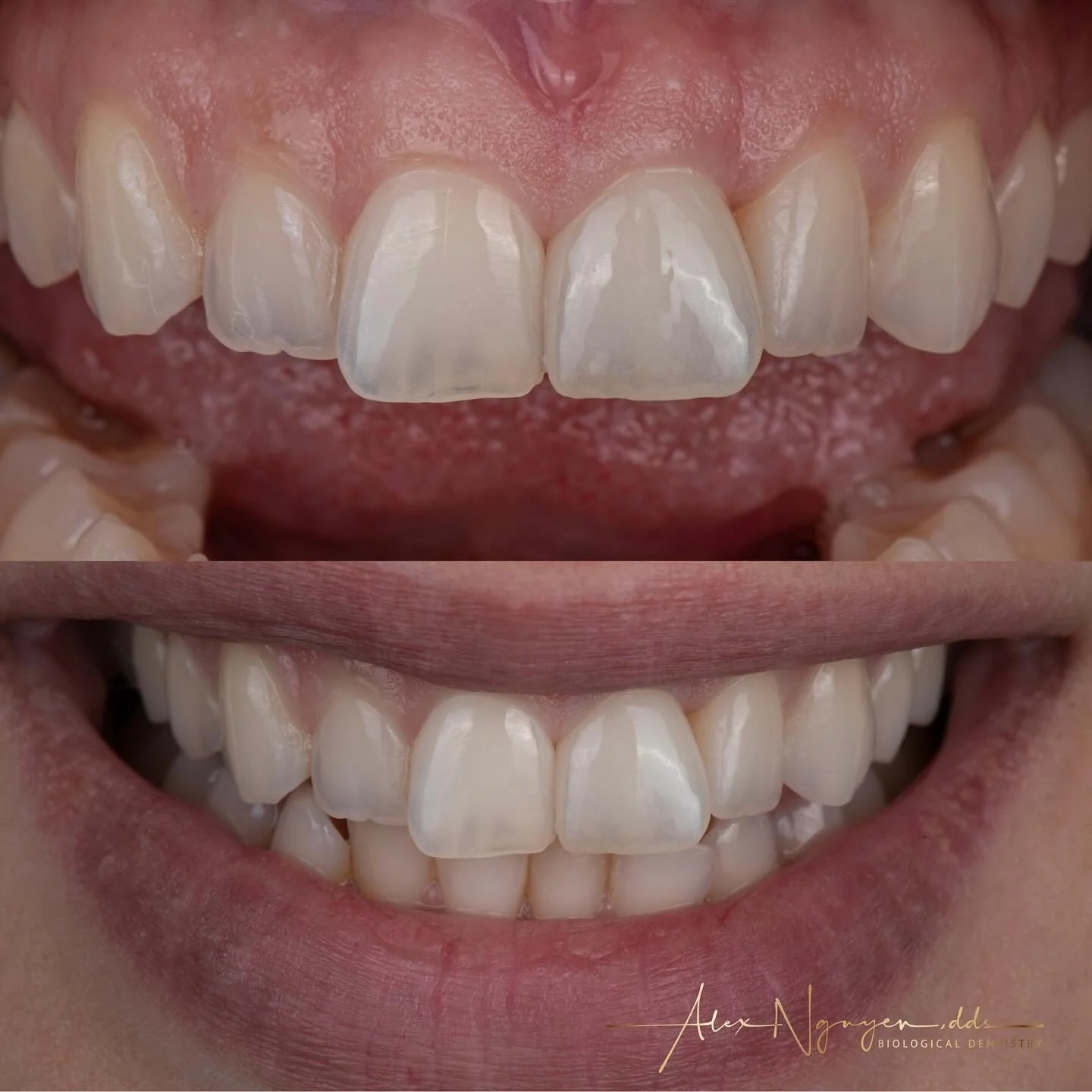 Replacing a front tooth with a ceramic implant and a single ceramic crown.
My patient lost her front tooth because she had an internal root resorption leaving a hole in her jaw bone.
We did an extraction with immediate implant and bone grafting.  The
