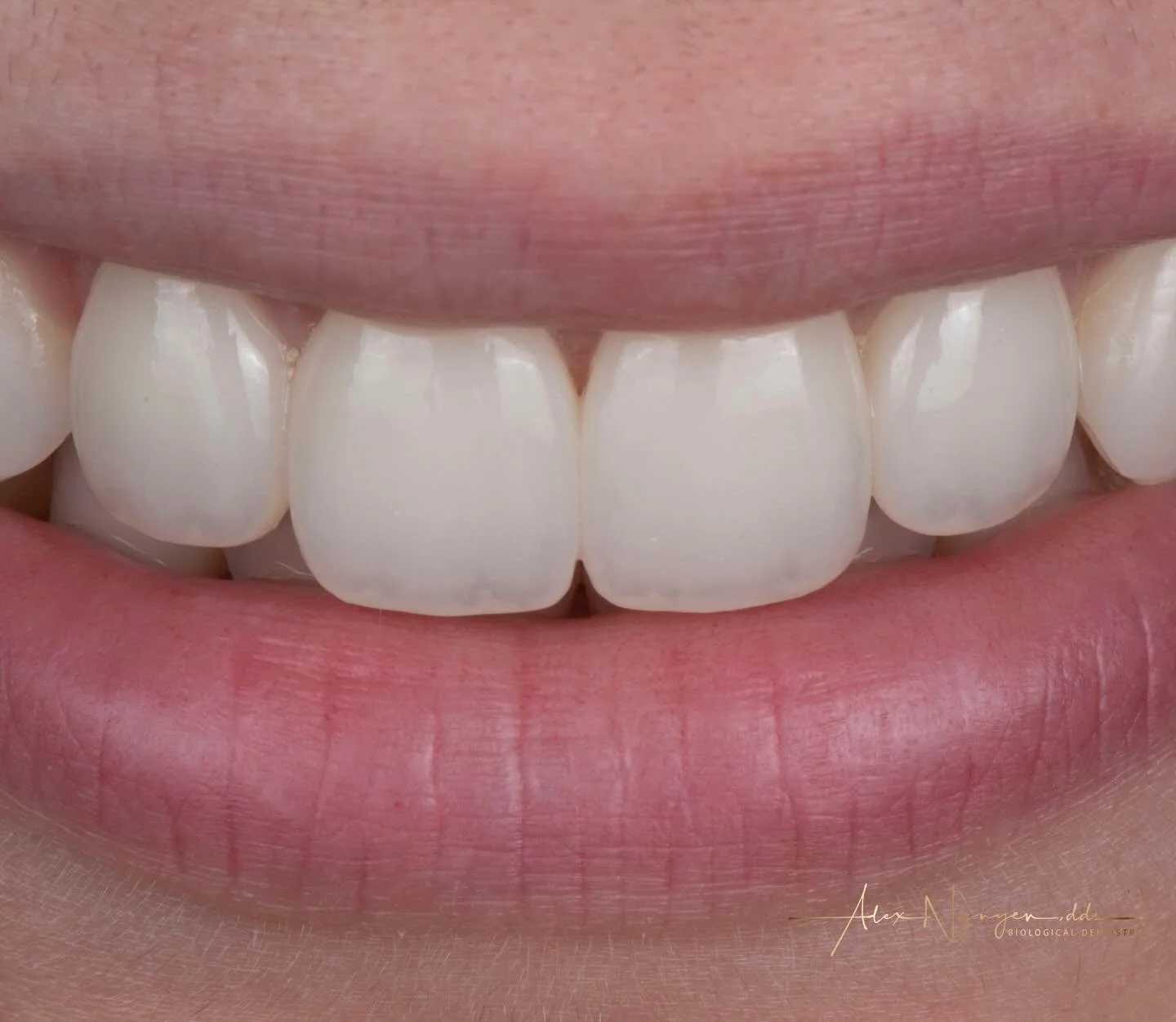 It&rsquo;s 2026!  Welcome to the world of modern dentistry materials and technique!
Are your veneers or porcelain crowns chipping away? 
One of the weak links in many beautiful porcelain restorations is the surface layered porcelain used to create th