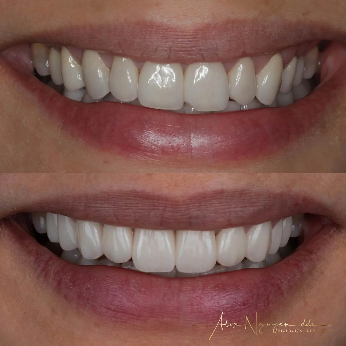 Replacing old fractured veneers and crown with modern custom designed ceramic materials. 
Here is another case where I did not use any layered porcelain.  Note the emphasis on surface texture and custom staining to create realistic depth and details,