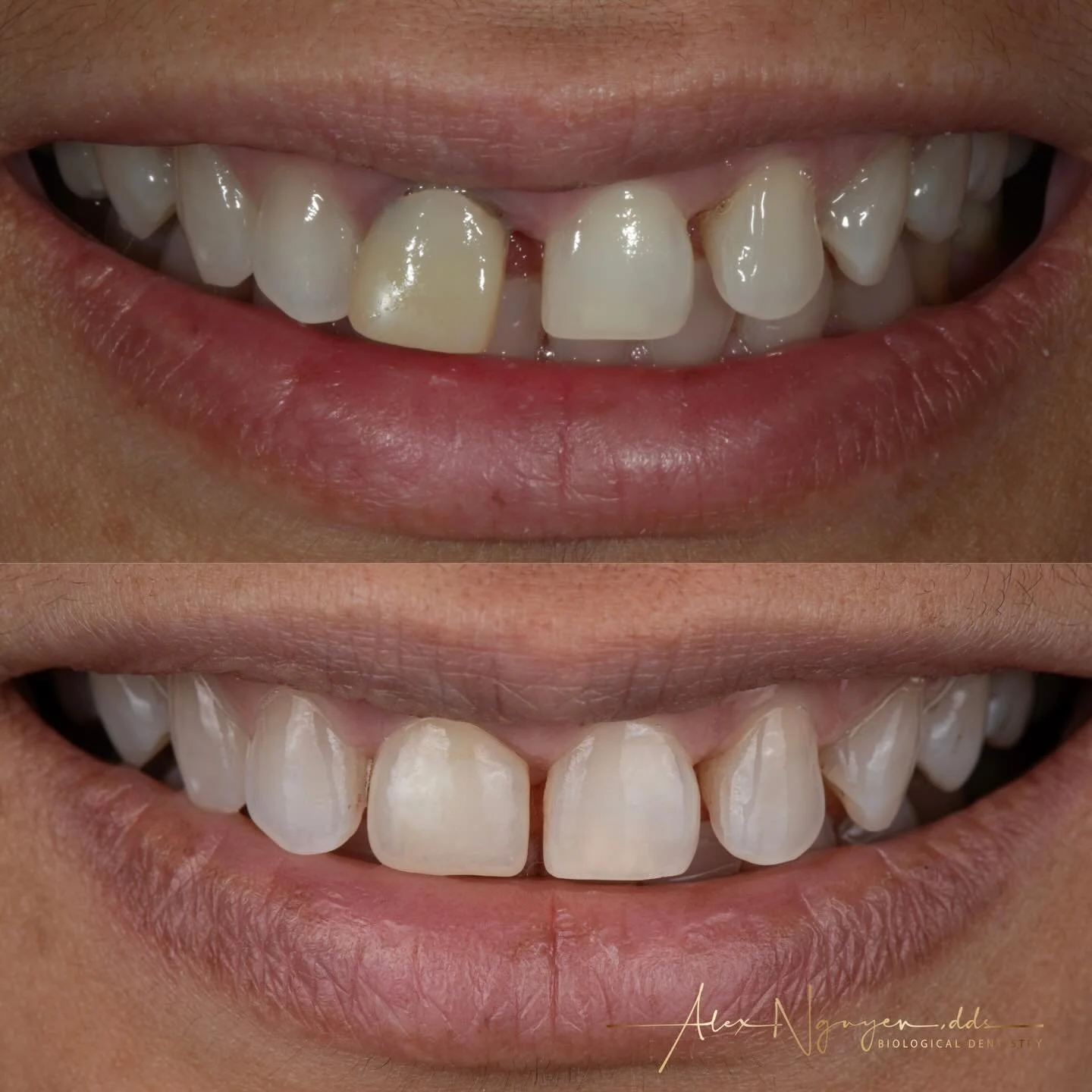 Single tooth ceramic implant and ceramic crown.
My patient&rsquo;s root canal treated tooth failed and started to exfoliate.  Failed root canals not only create functional and esthetic issues, they harbor bacteria and toxins that affect your immune s