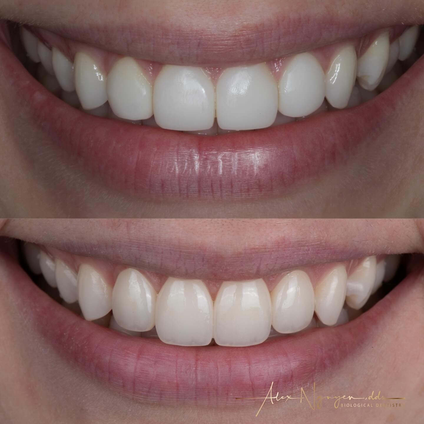 Four front teeth.
Replacing four composite veneers with four ceramic veneers that blend in naturally with the patient&rsquo;s own dentition.
-
-
-
-
#fourfrontteeth #ceramicveneers #ceramiccrowns #bayareadentist #alexnguyendds