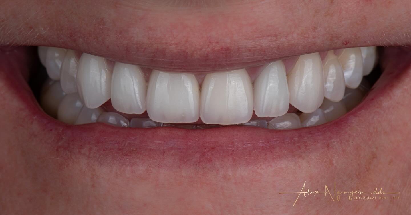 How long do veneers last?  How about roughly 19 years and going?  Yes&hellip;I delivered this case on April 17, 2007.  This photo was taken March 10, 2026.
The ball is in the patients court after we&rsquo;ve done everything to put a case together.  F