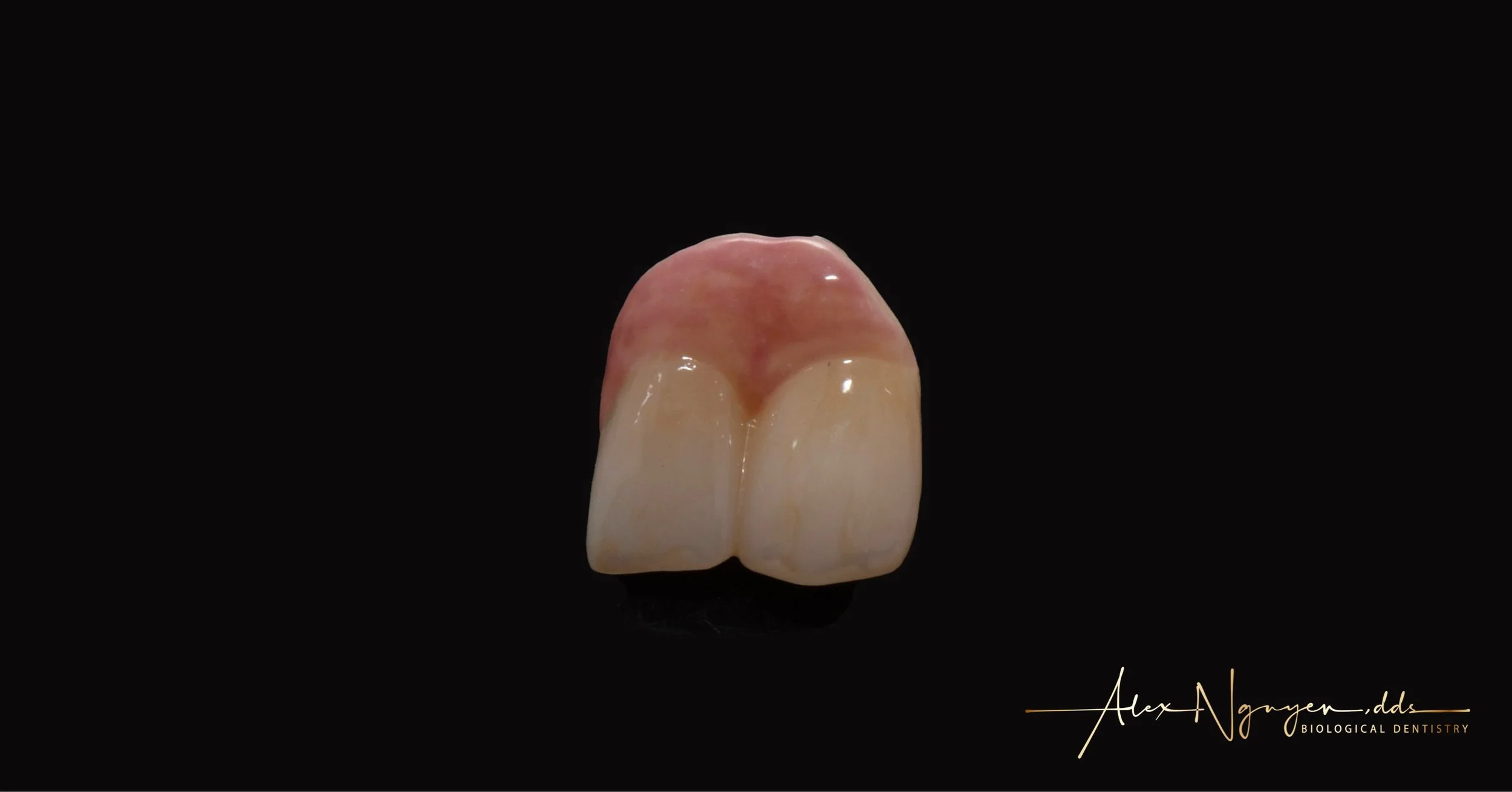 Catching up on social media after a long busy summer.
Another beautiful ceramic art work to replace my patient&rsquo;s missing teeth.  If we only do the entire restoration in white, then the teeth would appear too long in the mouth.
In this case we m