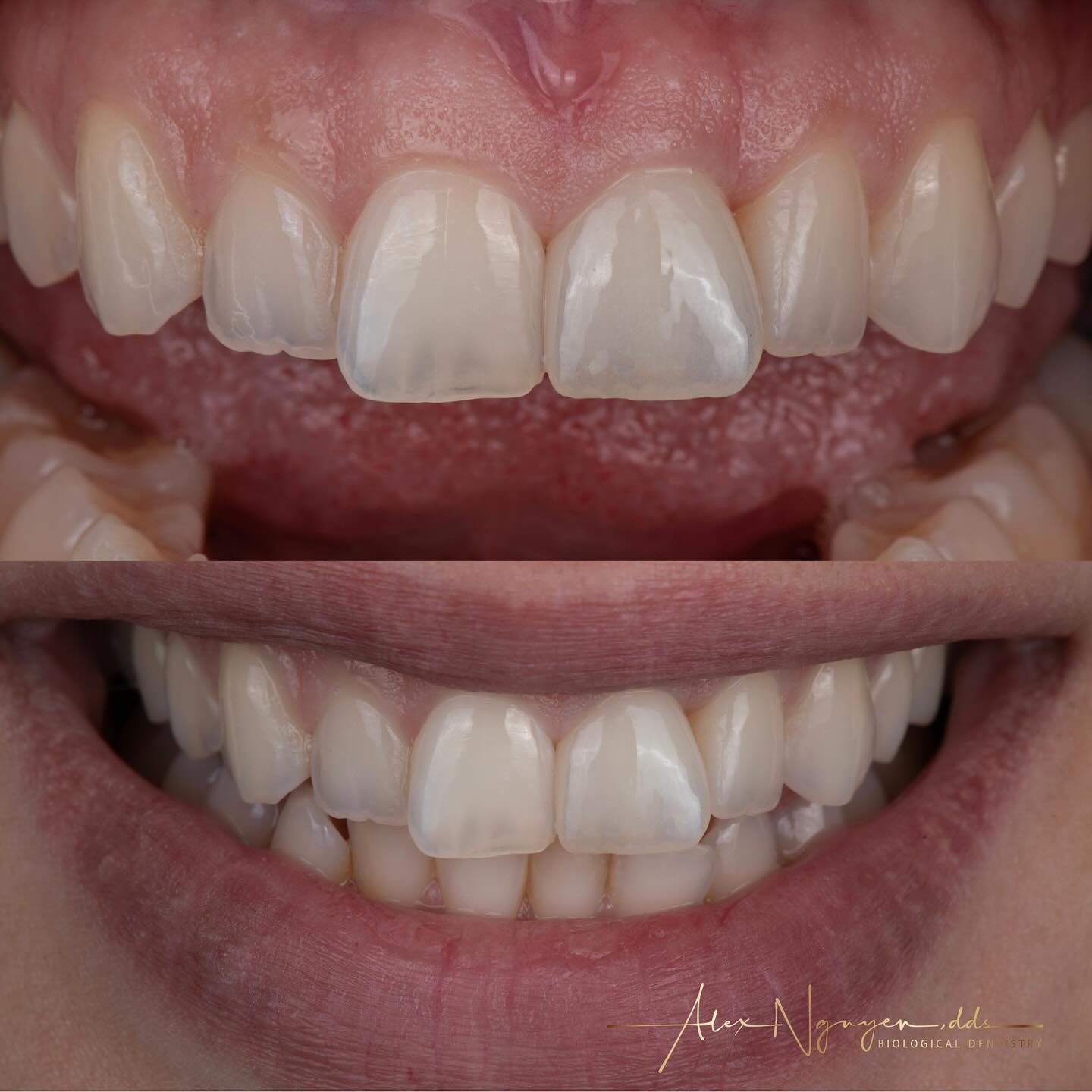 Replacing a front tooth with a ceramic implant and a single ceramic crown.
My patient lost her front tooth because she had an internal root resorption leaving a hole in her jaw bone.
We did an extraction with immediate implant and bone grafting.  The
