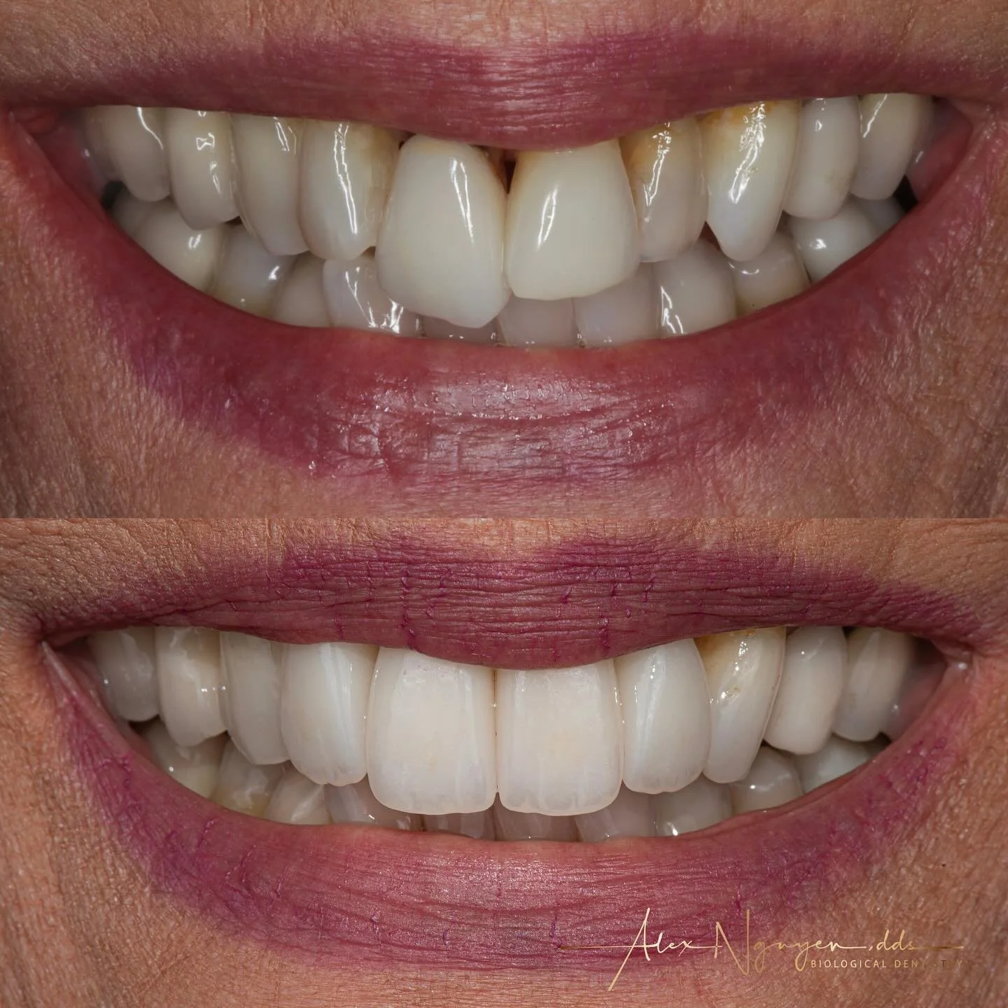 Using intentional imperfections in smile enhancements because real teeth are never perfect. Each smile enhancement case should be customized and age appropriate. 
In this smile the natural teeth have a lot of overlaps and uneven shape of teeth.  We p