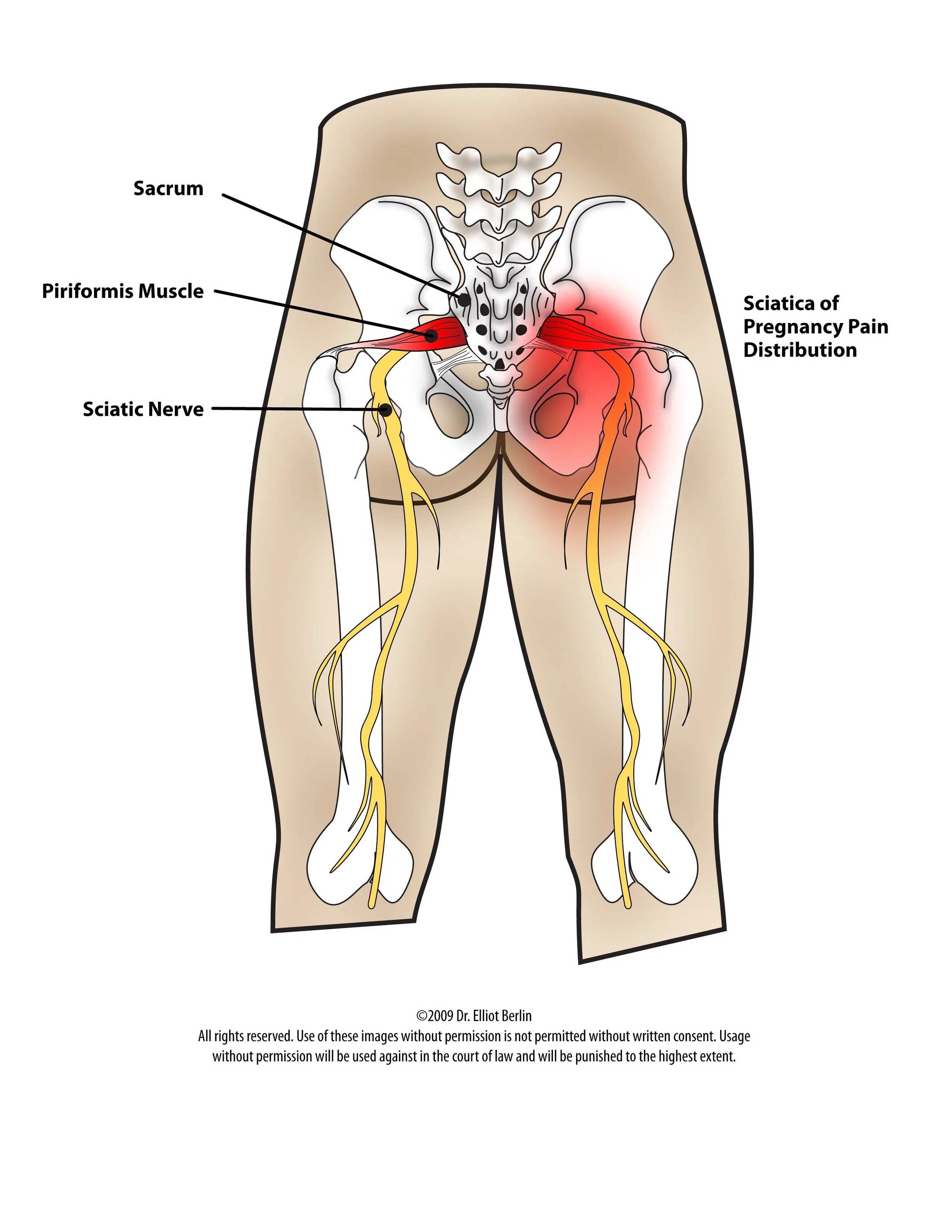 sciatica.jpg