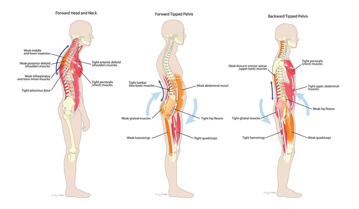Poor back Postures.png