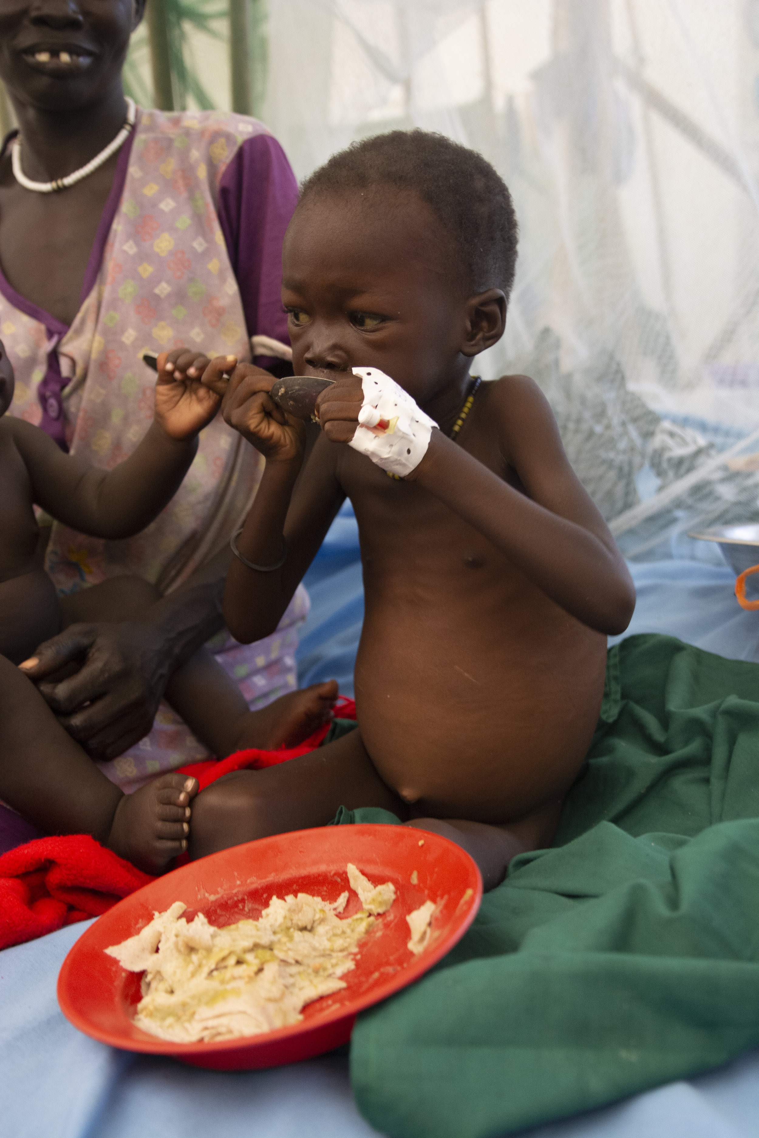  Malnutrition is epidemic in the outlying areas of Malakal. Because of fighting, many families fled to the bush where access to food and medical care is limited or non-existent. Forced to eat roots and drink dirty water many suffer from Kwashiorkor, 