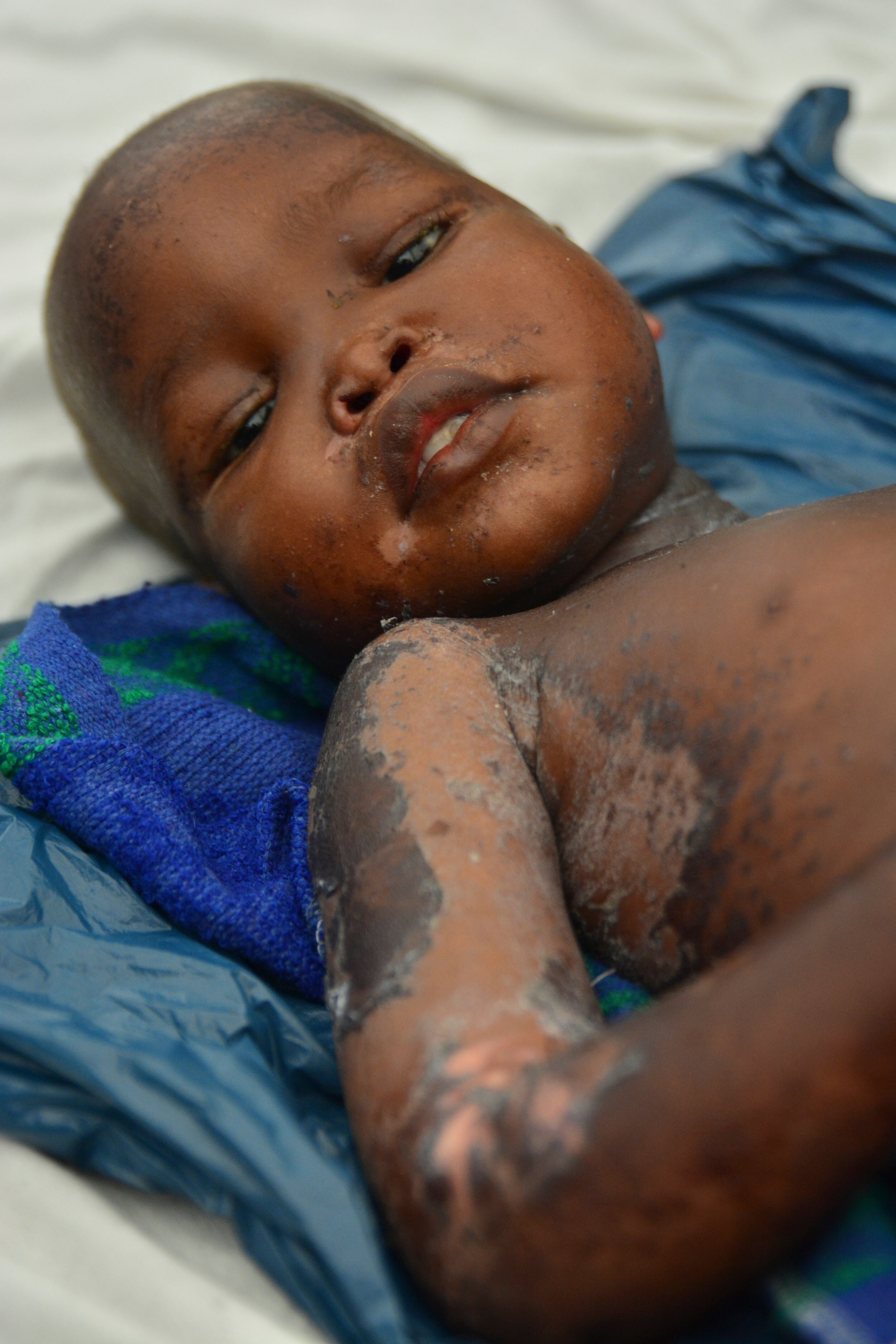  The most severe cases of malnutrition are treated in the Doctors Without Borders facility at the UNMISS base in Malakal. Children here are affected by a specific type of malnutrition called Kwashiorkor. Symptoms include distended bellies, ulcers, an