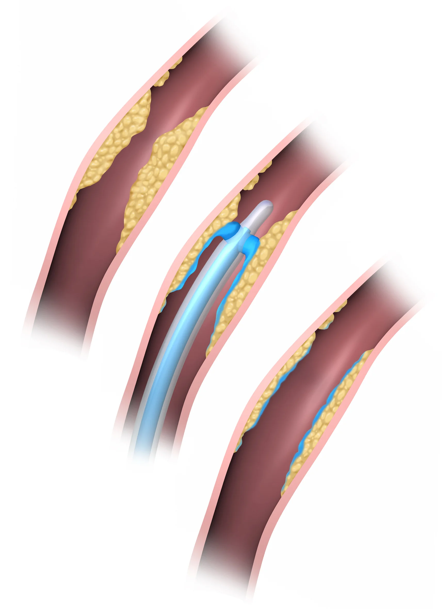 The Scientist Blood Vessel Procedure