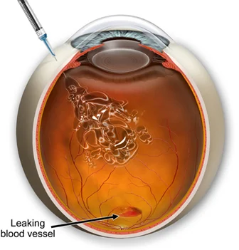 ARMD Injections