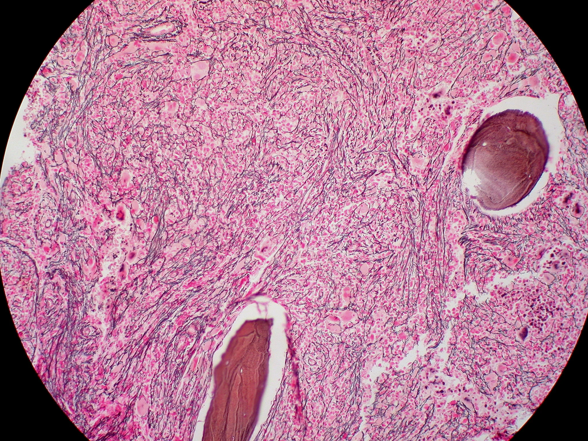 Myelofibrosis,_Reticulin_Stain_(6032644716).jpg