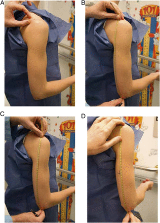 Figure 2 from Flynn et al, Pediatrics 2017 Determination of proper BP cuff size. A, Marking spine extending from acromion process. B, Correct tape placement for upper arm length. C, Incorrect tape placement for upper arm length. D, Marking upper arm length midpoint