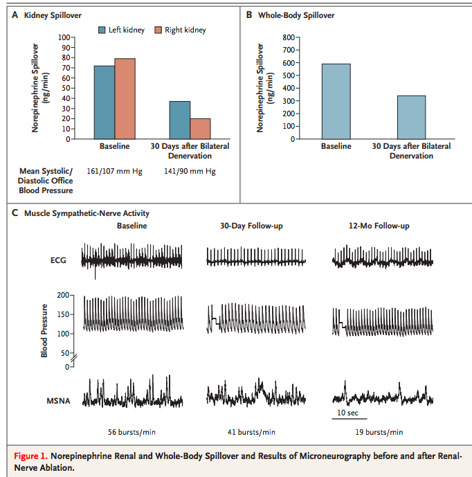From Schlaich et al, NEJM 2009: the first case report in the modern era of RDN