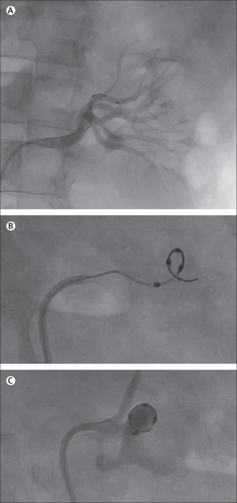 Figure 1 from Townsend et al, Lancet 2017