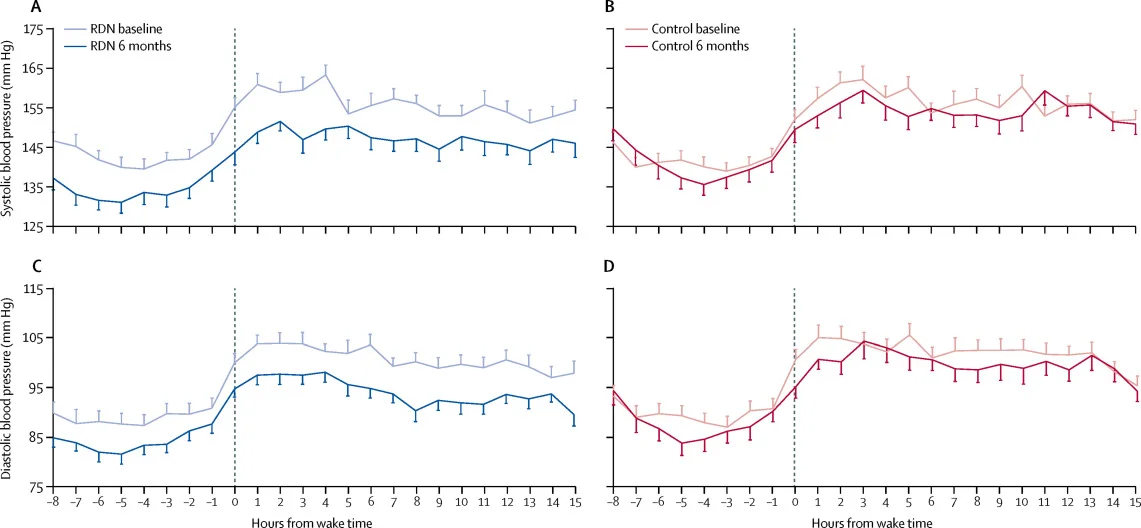 Figure 4 from Kandzari et al, Lancet 2018