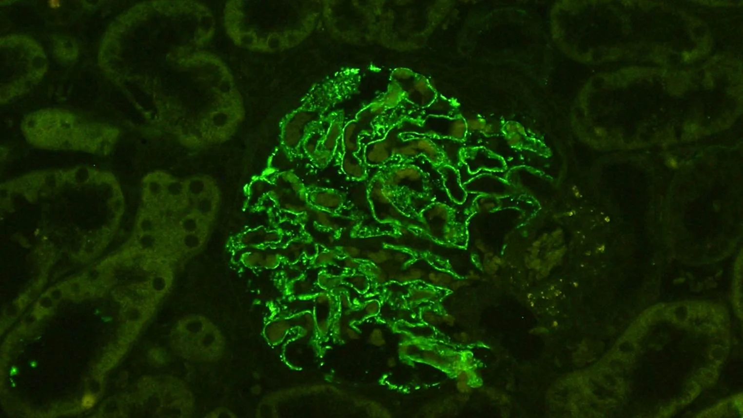 Courtesy of Arkana Labs. Strong anti-THSD7A staining on IF of a PMN biopsy.