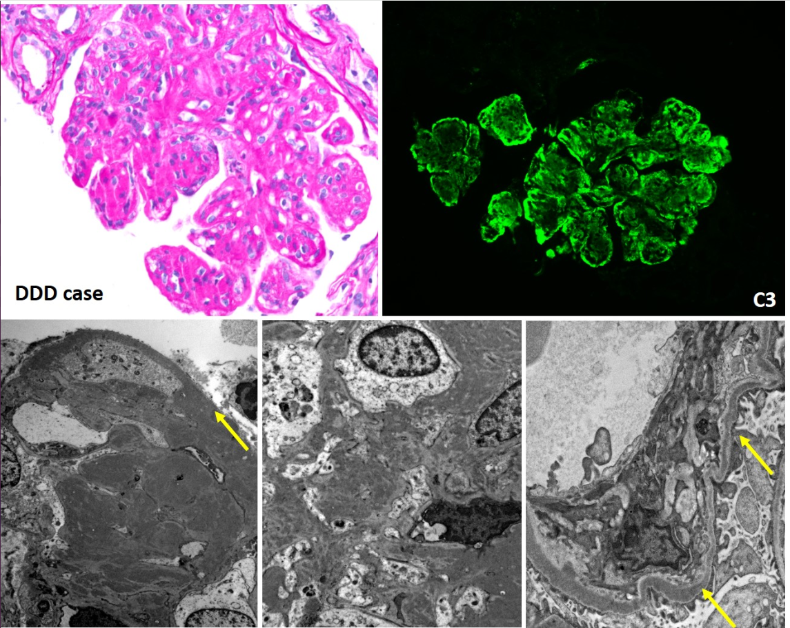 Shedding Light on the Dense Matter of C3 Glomerulopathy — NephJC