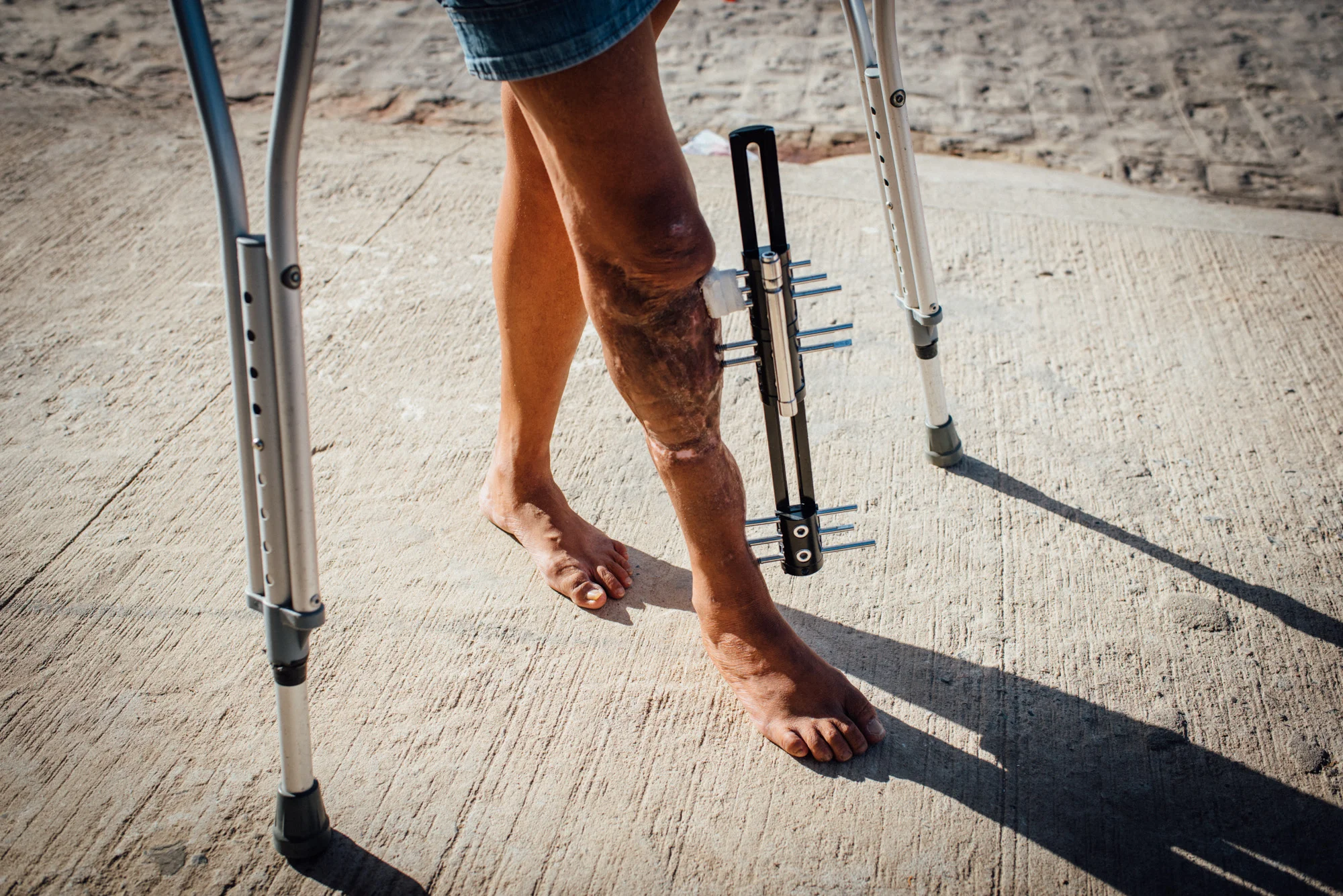 For 8 years now, Teresa Tanya, 43, has lived with an external fixator on her right leg. She was in a motorcycle accident and subsequently contracted osteomyelitis, an infection of the bone. One of the tougher obstacles that residents of the Irma Dulce projects have to overcome is access to healthcare. According to Tanya at the local public clinic 20 minutes away, "They only treat stomach aches and high blood pressure".